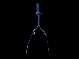 Aortofemoral 3D 模型
