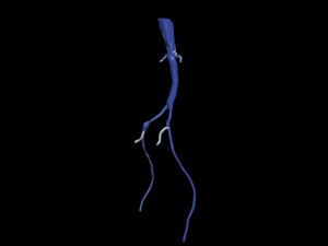 Aortofemoral 3Dモデル