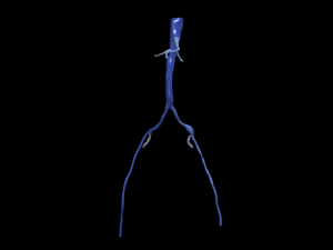Aortofemoral 3Dモデル
