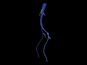Aortofemoral 3Dモデル