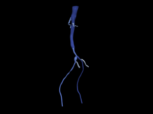 Aortofemoral 3Dモデル