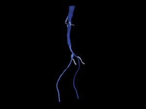 Aortofemoral 3D Modell