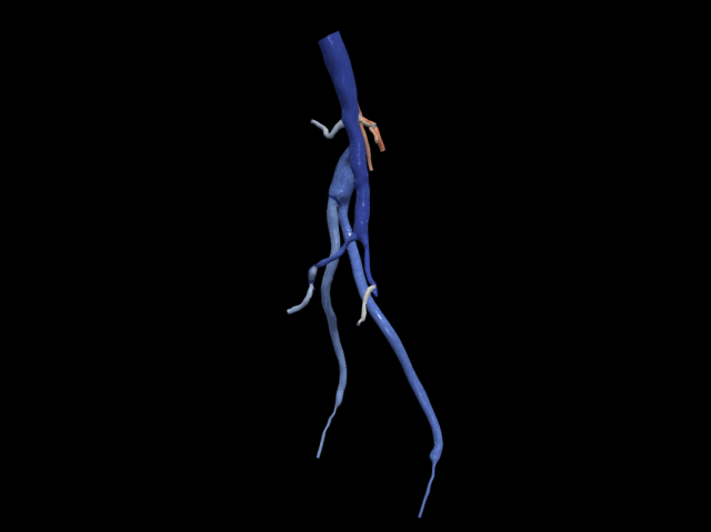 Aortofemoral Modelo 3D .c4d .max .obj .3ds .fbx .stl .blend 