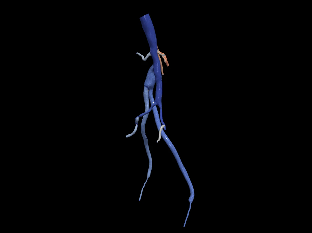 Aortofemoral 3D Model .c4d .max .obj .3ds .fbx .stl .blend 