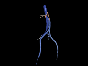 Aortofemoral Modelo 3D