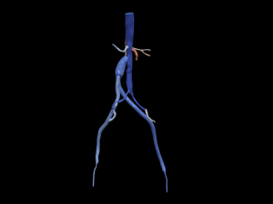 Aortofemoral Modelo 3D