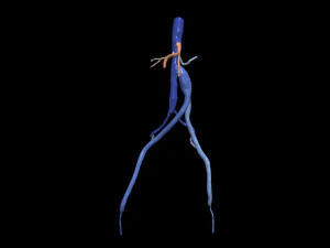 Aortofemoral 3D Model