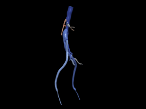 Aortofemoral Modelo 3D