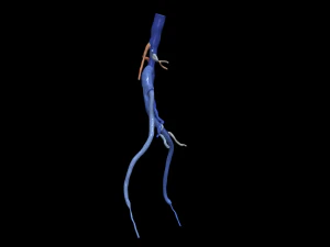 Aortofemoral 3D Model