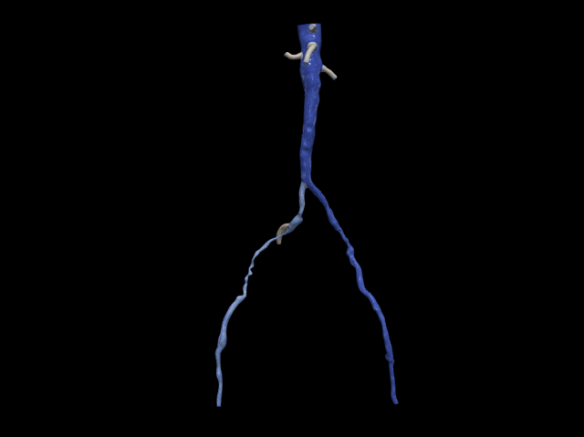 Aortofemoral 3D Model .c4d .max .obj .3ds .fbx .stl .blend 