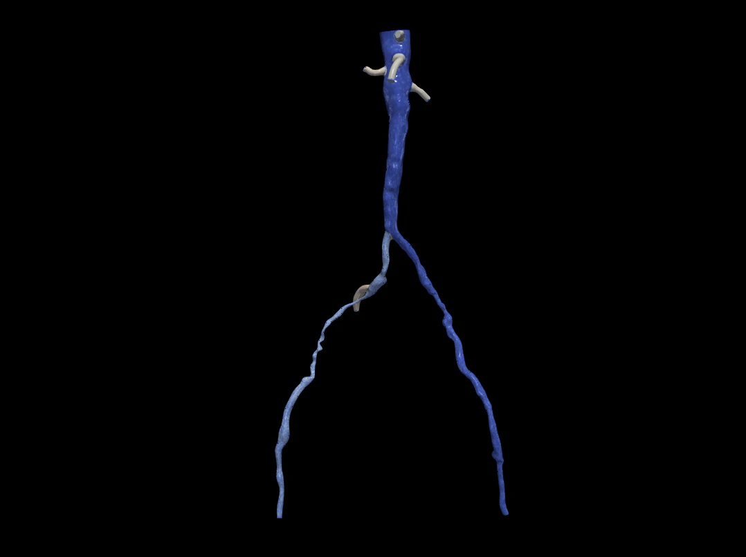 Aortofemoral 3D Model .c4d .max .obj .3ds .fbx .stl .blend 