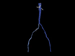 Aortofemoral 3D Modell