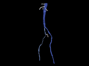 Aortofemoral 3D Model