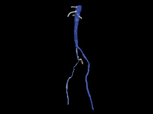 Aortofemoral 3D Model