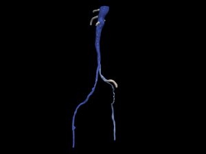 Aortofemoral 3D Model