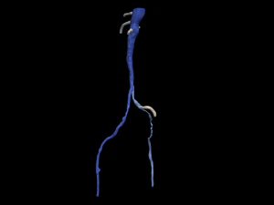 Aortofemoral 3D Model