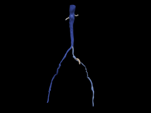 Aortofemoral 3D Model