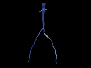 Aortofemoral 3D Model
