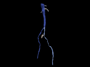Aortofemoral 3D Model