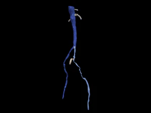Aortofemoral 3D Model
