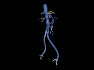 Aortofemoral Modelo 3D