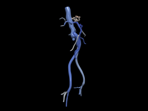 Aortofemoral Modelo 3D