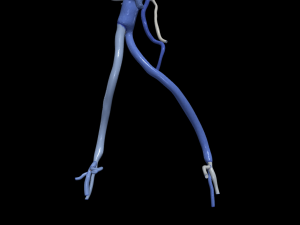 Aortofemoral Modelo 3D