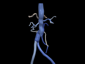 Aortofemoral Modelo 3D