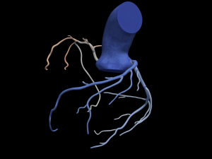 Coronary arteries 3D-Modell