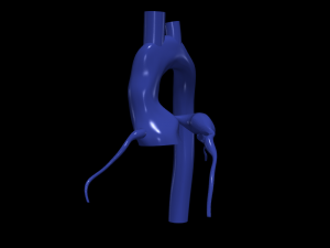 Coronary arteries and aorta 3D Model