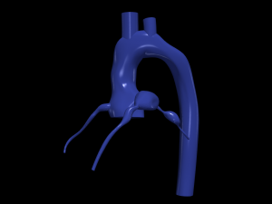 Coronary arteries and aorta 3D Model