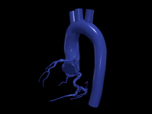 Coronary arteries and aorta 3D Model