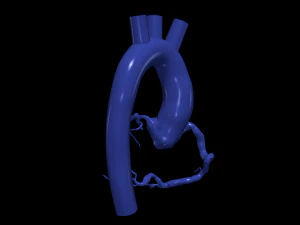 Coronary arteries and aorta 3D Model