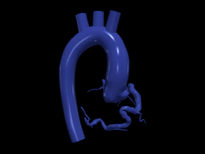 Coronary arteries and aorta 3D Model