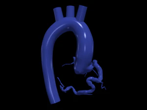 Coronary arteries and aorta 3D Model