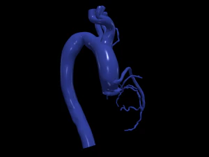 Coronary arteries and aorta 3D Model