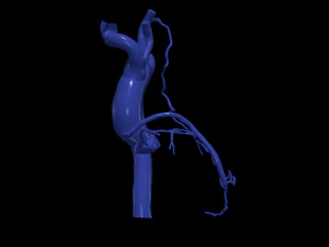 Coronary arteries and aorta 3D Model