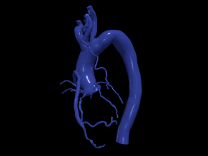 Coronary arteries and aorta 3D Model
