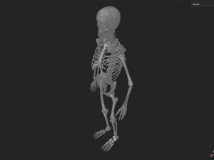 Surgical Skeleton 3D Model