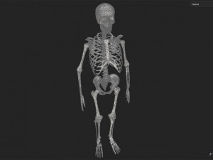 Surgical Skeleton 3D Model
