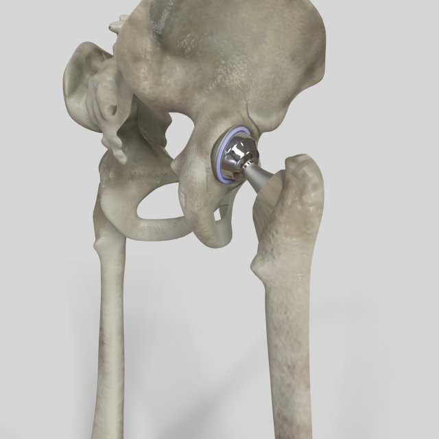 Hip Replacement 3D Model .c4d .max .obj .3ds .fbx .stl .blend 