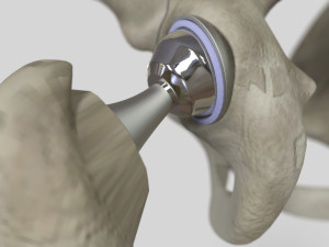 Hip Replacement 3D Model