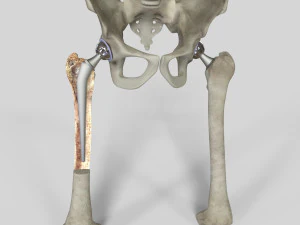 Substitui&ccedil;&atilde;o de quadril Modelo 3D