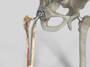 Hip Replacement 3D Model