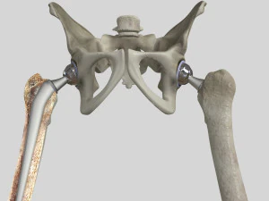 Substitui&ccedil;&atilde;o de quadril Modelo 3D
