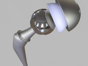 Substitui&ccedil;&atilde;o de quadril Modelo 3D