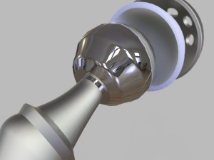 Hip Replacement 3D Model
