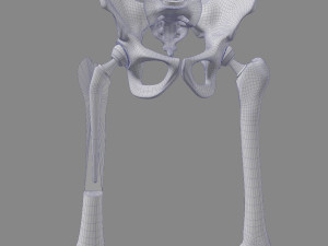 Hip Replacement 3D Model