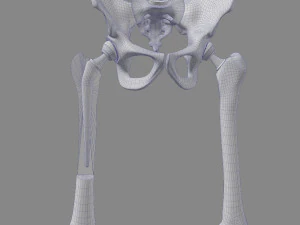 Substitui&ccedil;&atilde;o de quadril Modelo 3D