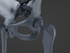 Hip Replacement 3D Model